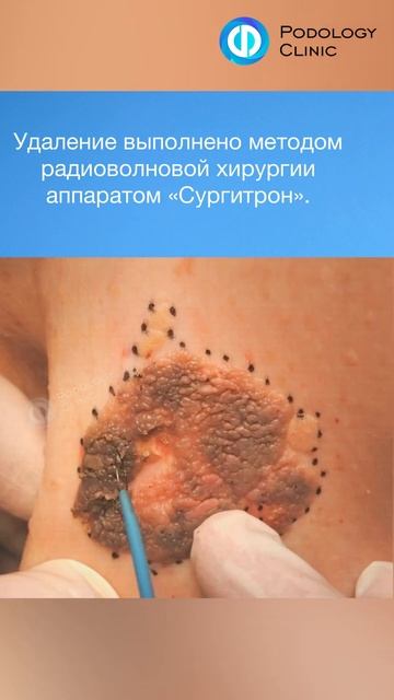 Удаление кератомы #дерматология #дерматологмосква #удалениеновообразований #дерматолог #кератома