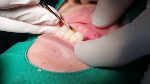 서하플란트치과 ezi-crown