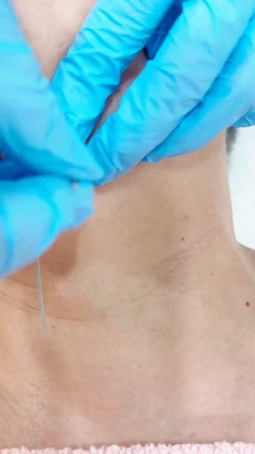Косметическое иглоукалывание #иглоукалывание #рефлексотерапия #acupressure #acupunсture #massage