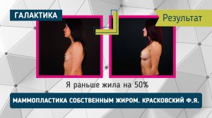Проект "Оморфия" маммопластика собственным жиром | Красковский Федор Янович