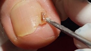 OVERGROWN INFECTED INGROWN TOENAIL REMOVAL