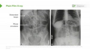 4.05 SBO- Examination & Diagnosis