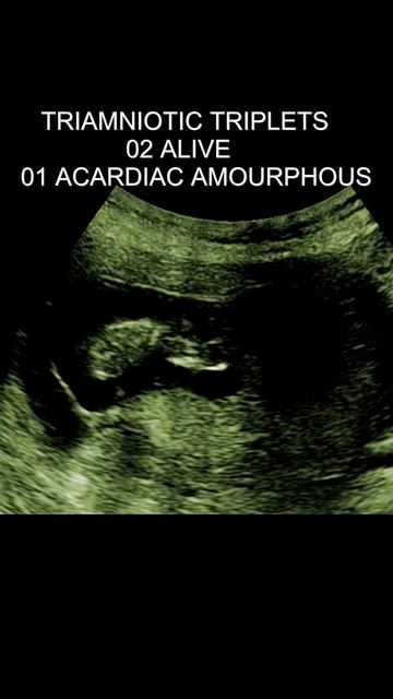 Acardiac amorphous twin, 08 WEEKS TRIPLETS, TRIAMNIOTIC, A2Z OF ULTRASOUND, ARDMS, APCA