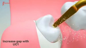 Peizo Surgery DTE The use of tips