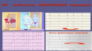 Электрофизиология механизмов мерцат аритмии и фибрилляции предсер Кошкина Е.В.
