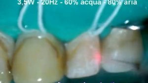 Doctor Smile PLUSER ER-YAG Laser İle Kompozit Uzaklaştırma