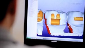 Процесс изготовления Брекеты  Incognito™ Appliance System