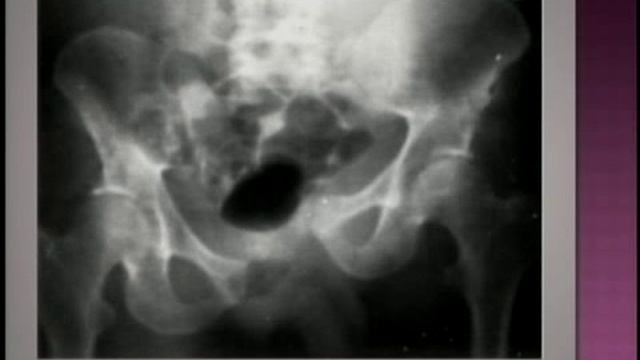 Pelvic Trauma смотреть онлайн