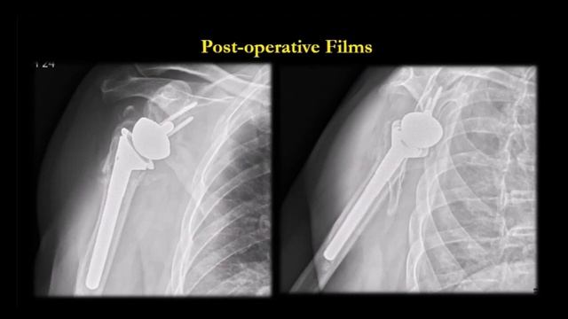 Reverse Total Shoulder Arthroplasty in Proximal Humerus Fracture Sequelae A/ Prof.Bancha Chernchuji смотреть онлайн