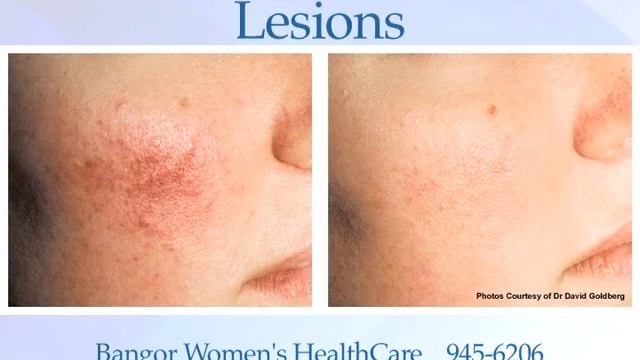 GentleMax Laser, Robert Grover, DO смотреть онлайн