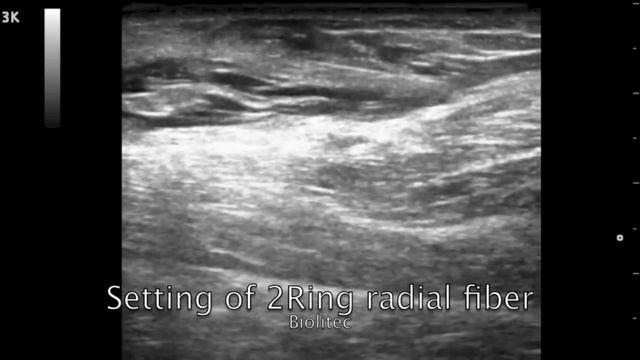 Laser Ablation of perforating vein with 2Ring radial fiber смотреть онлайн