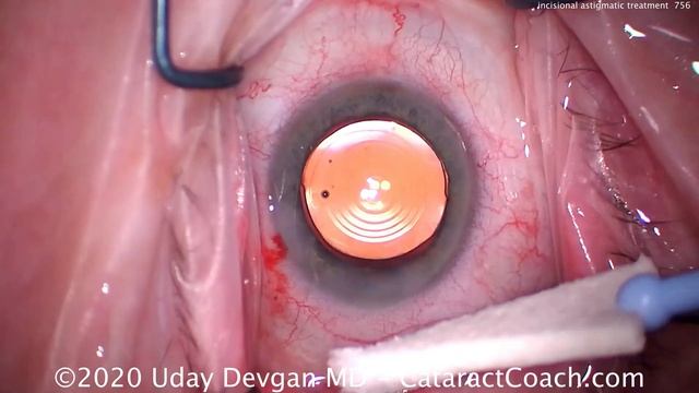 Incisional Techniques to treat low astigmatism during cataract surgery смотреть онлайн