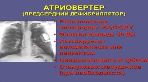 Лечение аритмий всеми методами Кошкина Е. В