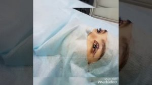 Оперированный птоз верхнего века.  RB clinic  87027471177