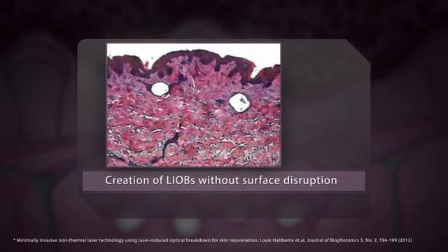 PicoWay Resolve Holographic Fractional