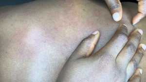 ASMR NITPICKING BRAIN MELTING ~WITH BUBBLEGUM