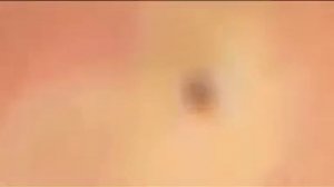 Nặn mụn đầu đen/ черные прыщи