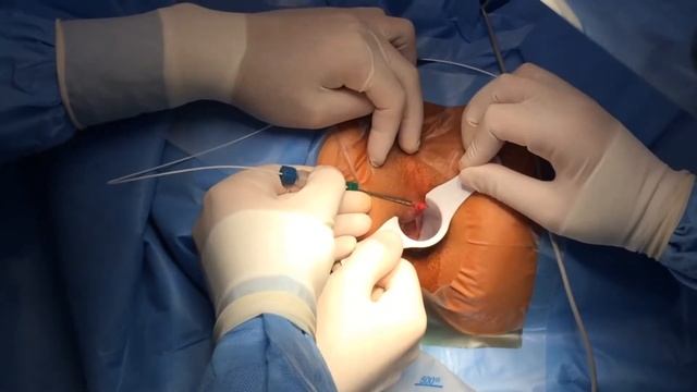 Laser Haemorrhoidoplasty смотреть онлайн