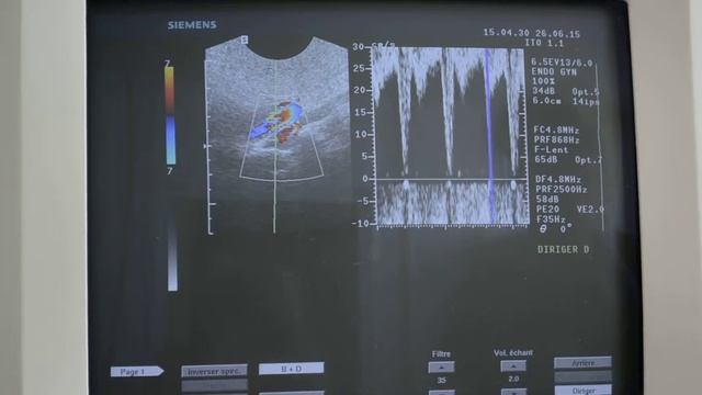 ECHOGRAPHE SIEMENS SONOLINE ELEGRA D'OCCASION смотреть онлайн