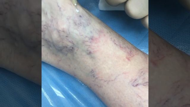 Склеротерапия в клинике "Варикоза нет"