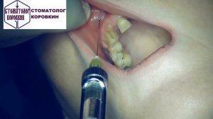 Инфильтрационная анестезия для удаления 12.