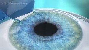 02 LASIK FEMTO LASIK animation splitscreen copyright