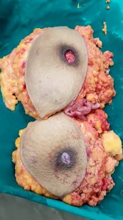 PART 2. FTM Top Surgery Double incision mastectomy with free nipple graft