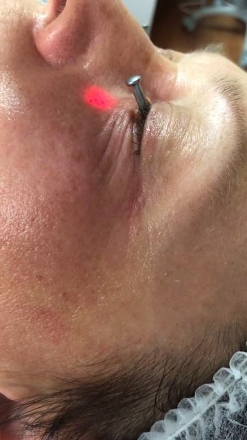 Лазерная блефаропластика. Салон Лилу Кременчуг смотреть онлайн