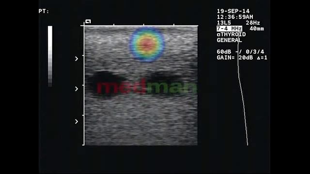 Siemens Acuson Aspen - 13L5 - głowica USG смотреть онлайн