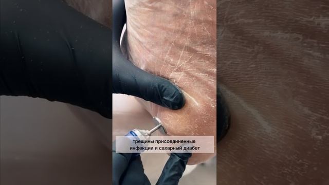 Smart педикюр. Педикюр Смарт "Идеальная стопа" смотреть онлайн