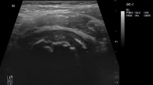 Болезнь Пертеса