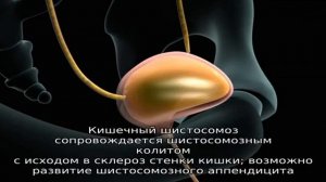 Шистосомоз