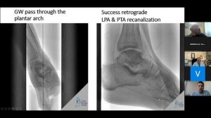 Below the knee lesion. Case report.