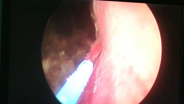 Thulium Laser Transurethral resection of the prostate -Vasil Angelov M.D. смотреть онлайн