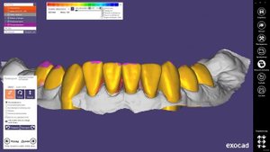 Виниры Exocad: 3) постановка зубов / Veneers Exocad: 3) teeth positioning