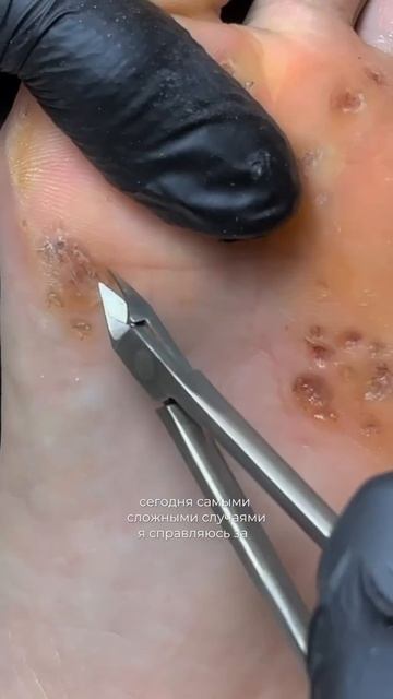 Как справиться с бородавками за 3 визита смотреть онлайн