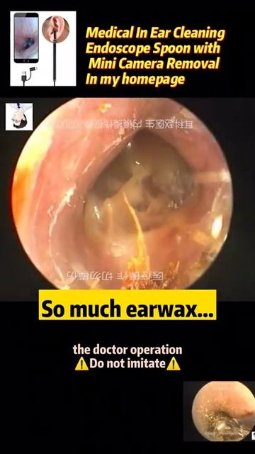 Best Ear Wax Removal & Extraction with Vacuum Remover 真空リムーバーによるにきびの除去と抽出 148 смотреть онлайн