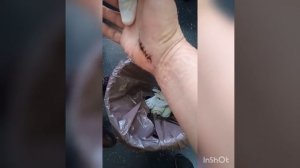 Синдром карпального канала. (12 дней, продолжаем с повязкой)