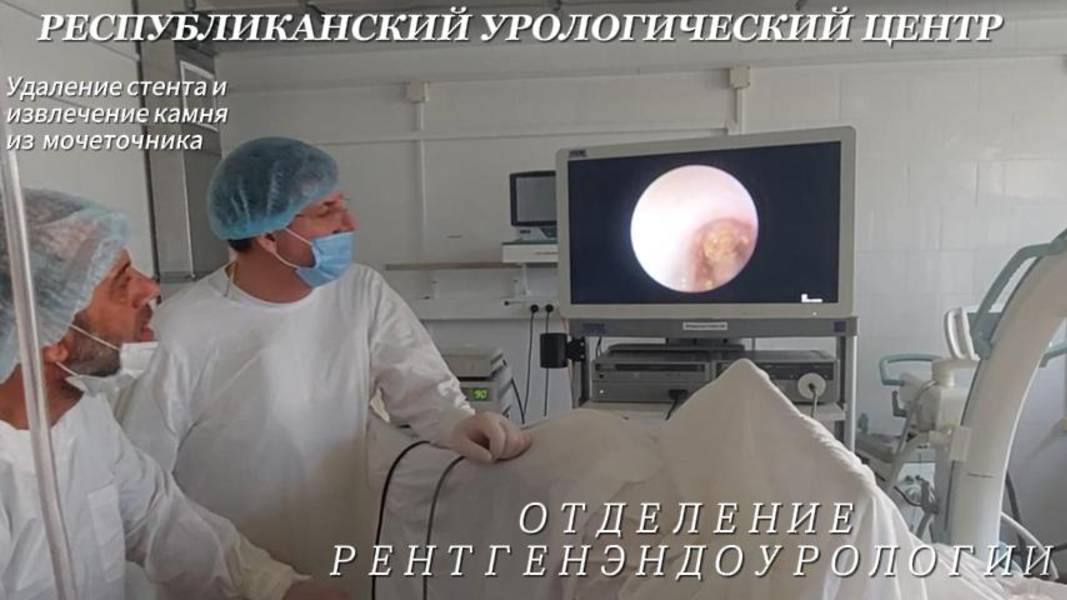Удаление стента и извлечение камня из мочеточника