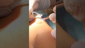 Удаление лазером папиллом 1