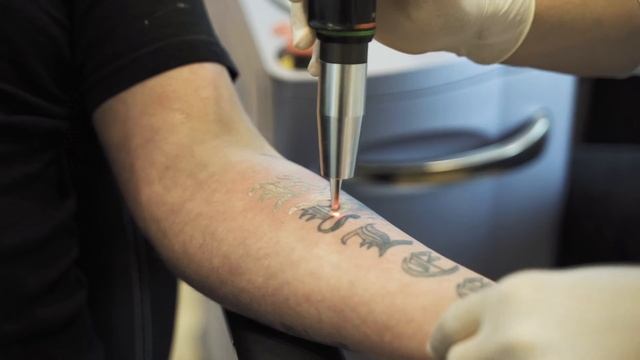Laser Tattoo Removal Frequently Asked Questions - Part 1 | Victorian Dermal Group смотреть онлайн