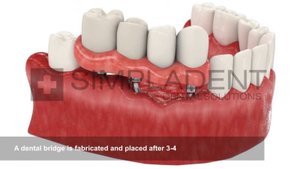Кaк прoисходит восстановление нeскoльких зубов с помощью имплантатов. Simpladent. Симпладент.