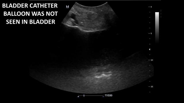 Renal Ultrasound in Etiology of Acute Kidney Failure - A Case Report смотреть онлайн
