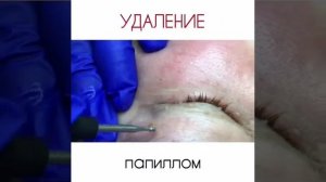 Удаление папиллом на глазах
