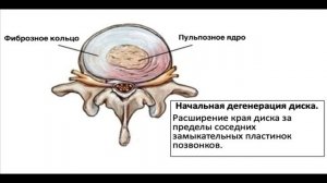 Грыжи межпозвоночных дисков, их разновидности, стадии