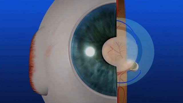YAG Laser Capsulotomy смотреть онлайн