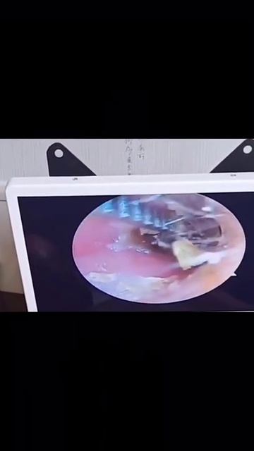 Best Ear Wax Removal & Extraction with Vacuum Remover 真空リムーバーによるにきびの除去と抽出 2 смотреть онлайн