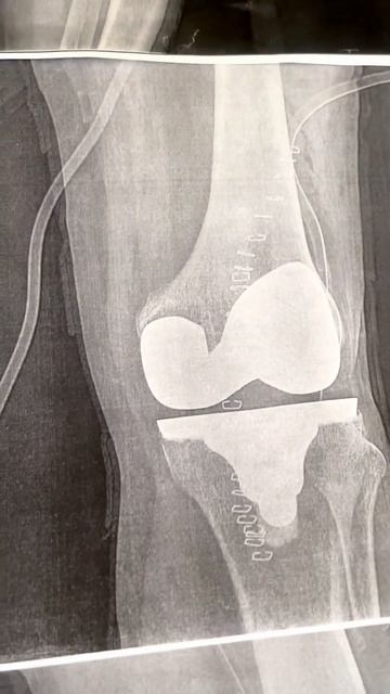 Рентгеновские снимки колена, ДО и после замены коленного сустава . смотреть онлайн
