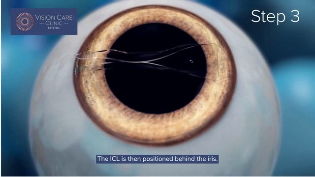 Vision Care Clinic - Implantable Contact Lenses (ICL) смотреть онлайн