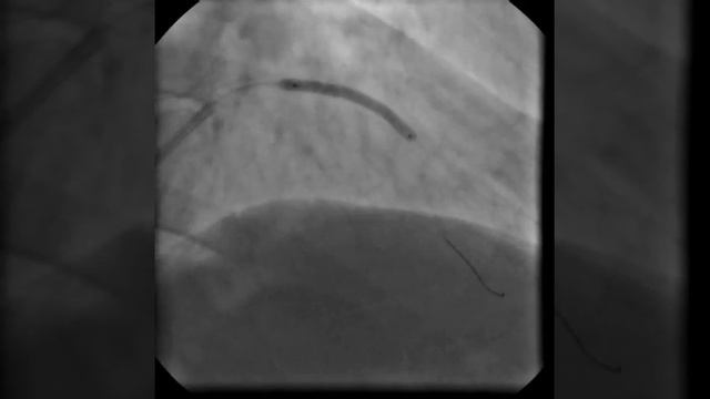 Имплантация стента 3 х 35 мм. в средний сегмент ПМЖВ. смотреть онлайн